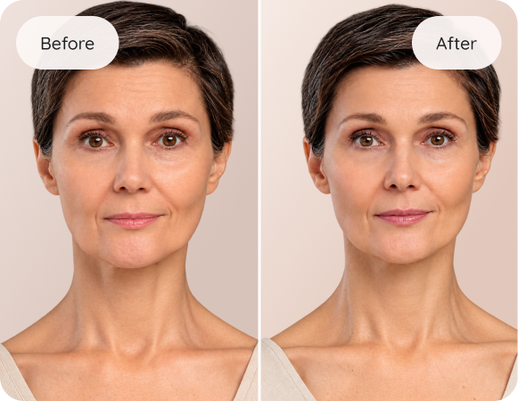 Before and after Botox results at Desert Med Rejuvenation in Rancho Mirage. Individual results may vary.