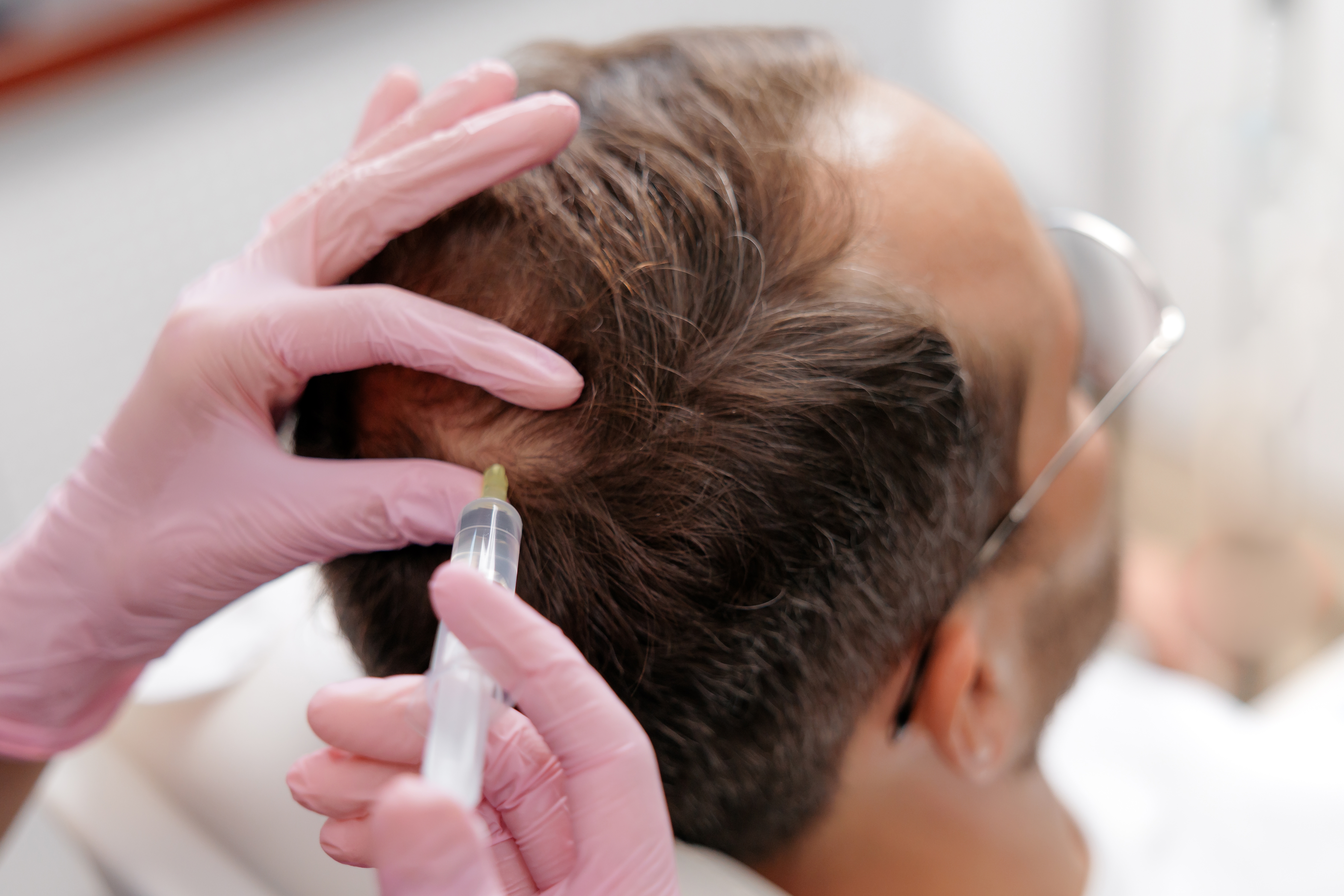 PRF hair restoration treatment at Desert Med Rejuvenation in Rancho Mirage.