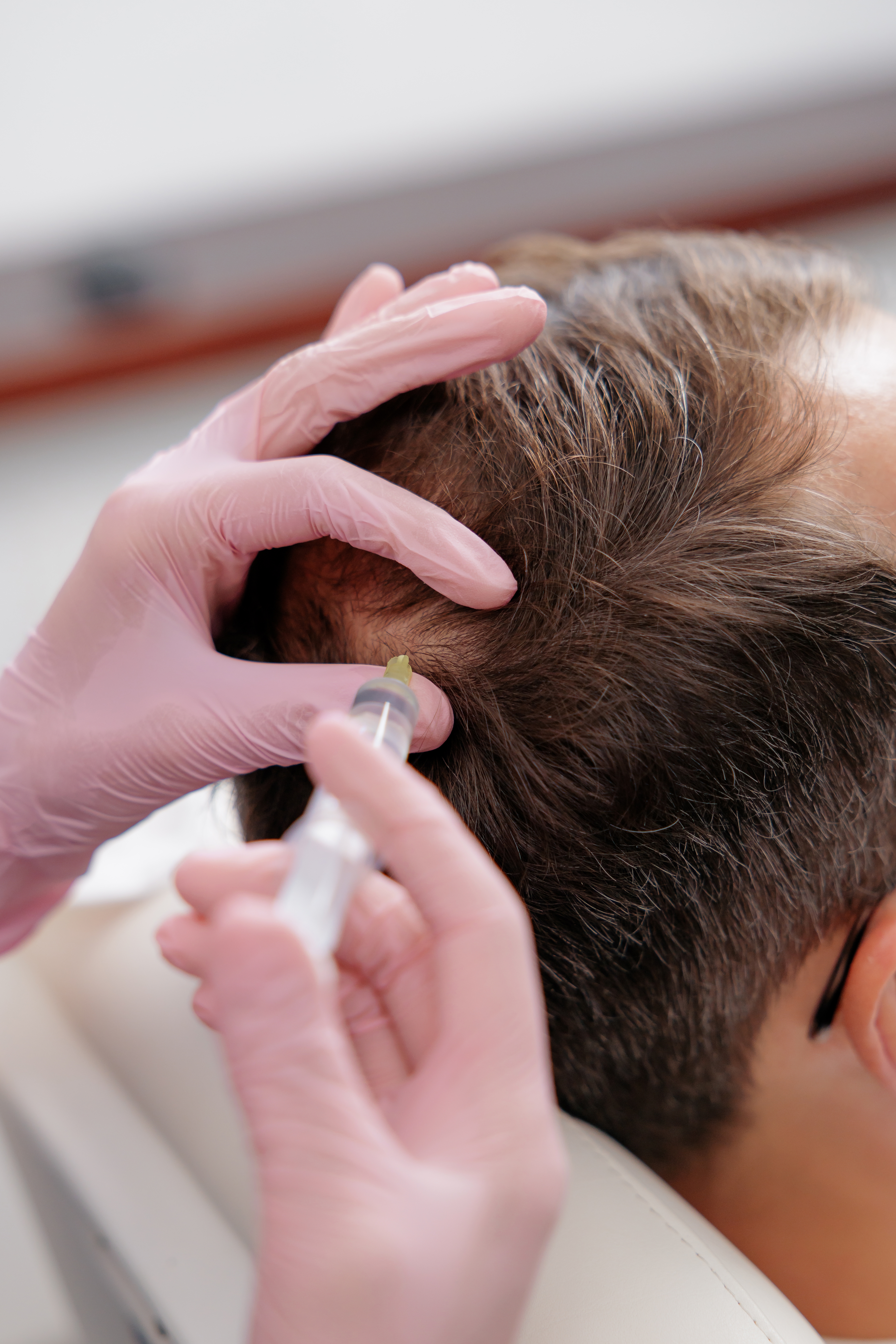 PRF being applied to a patient’s scalp during hair restoration at Desert Med Rejuvenation.