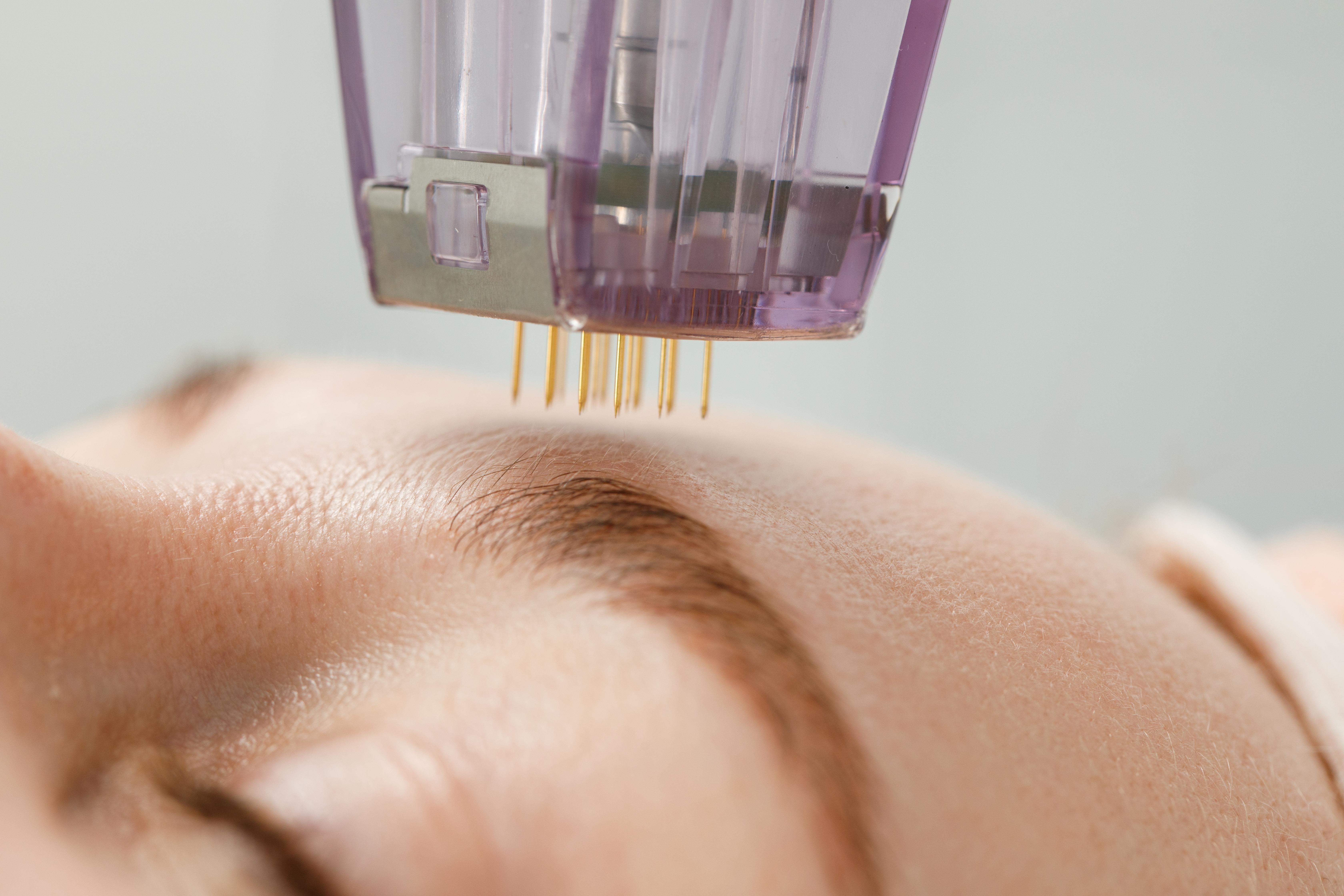 Patient with smooth, rejuvenated skin after microneedling with PRF at Desert Med Rejuvenation.