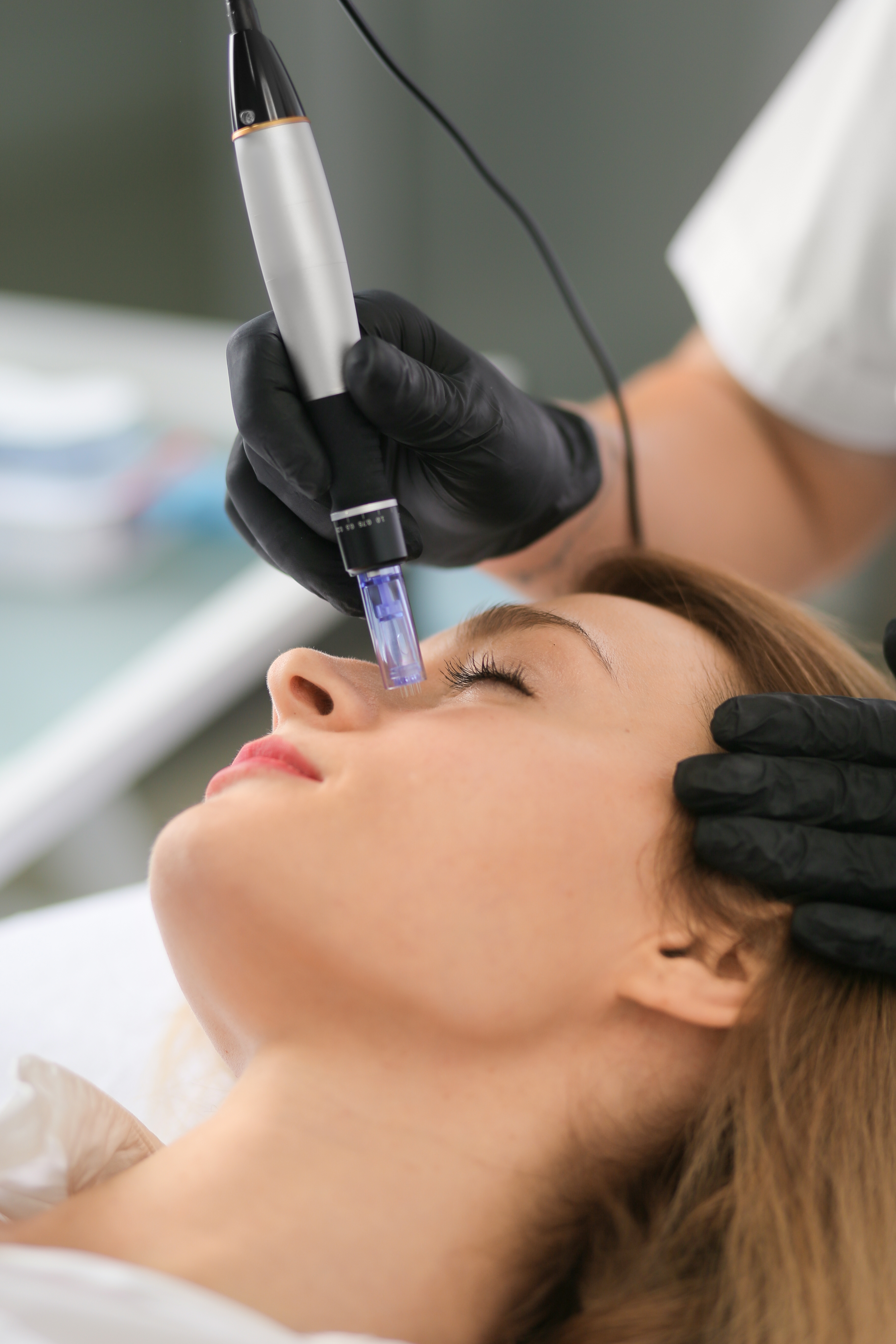 Microneedling pen applying PRF to a patient’s skin at Desert Med Rejuvenation.