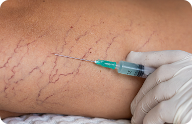 Sclerotherapy spider vein treatment at Desert Med Rejuvenation.