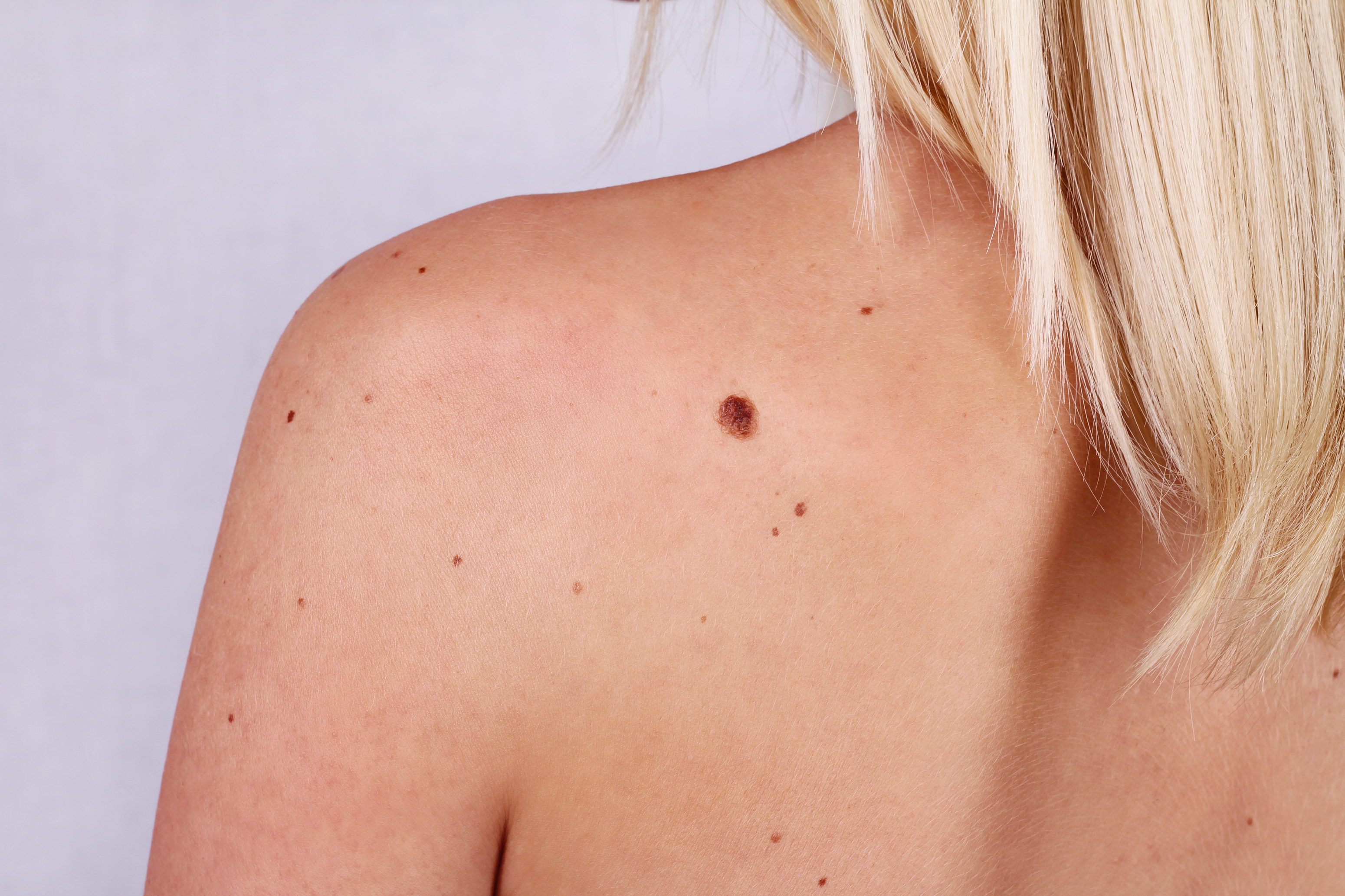 Mole removal treatment at Desert Med Rejuvenation.